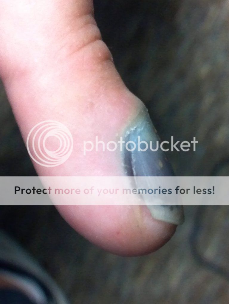 docs....How long until this fingernail falls off?